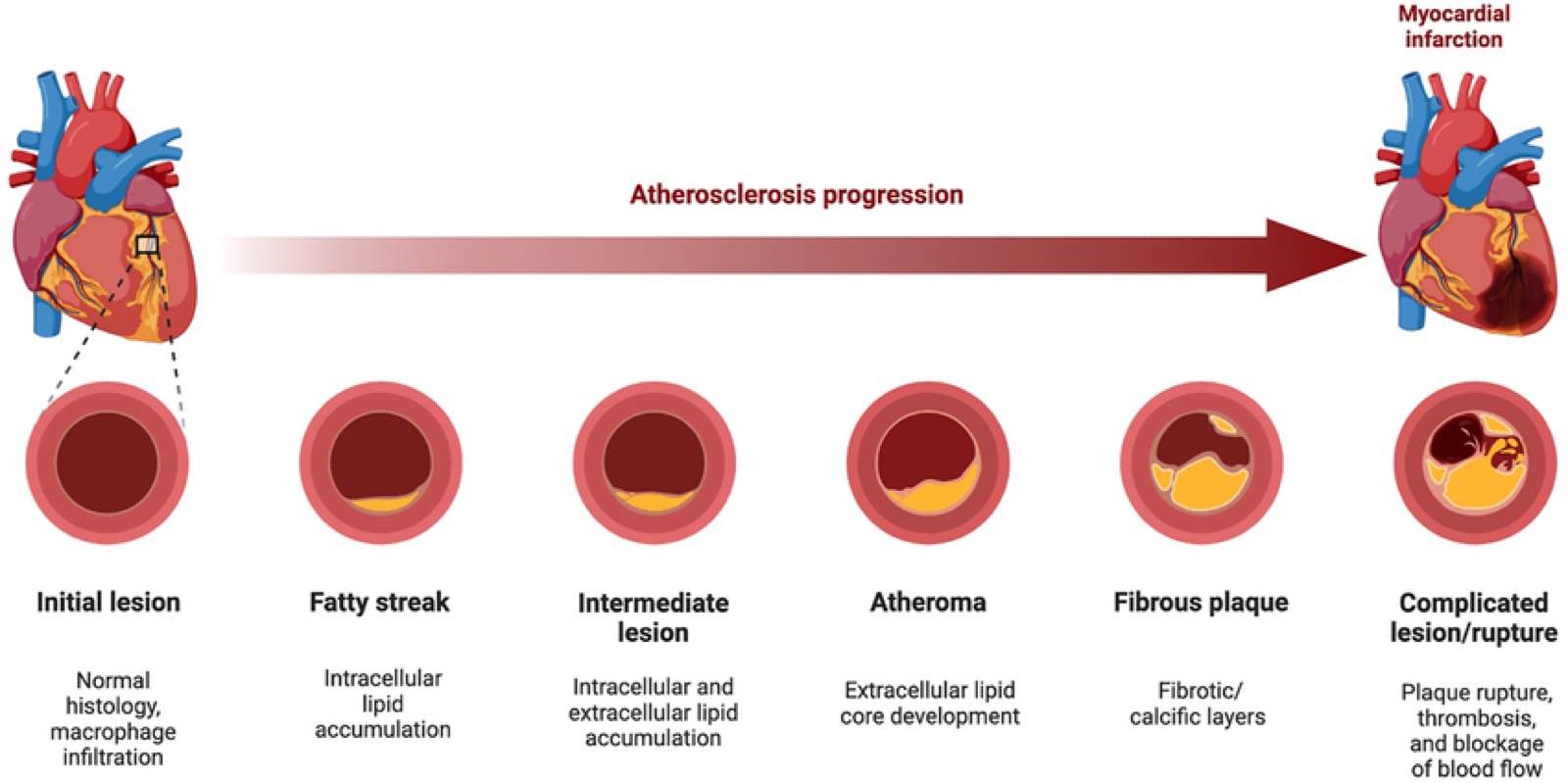 Understanding Coronary Artery Disease (illustrative image)